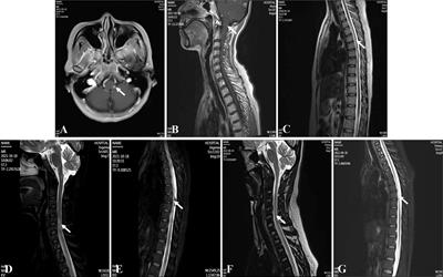 A meaningful exploration of ofatumumab in refractory NMOSD: a case report
